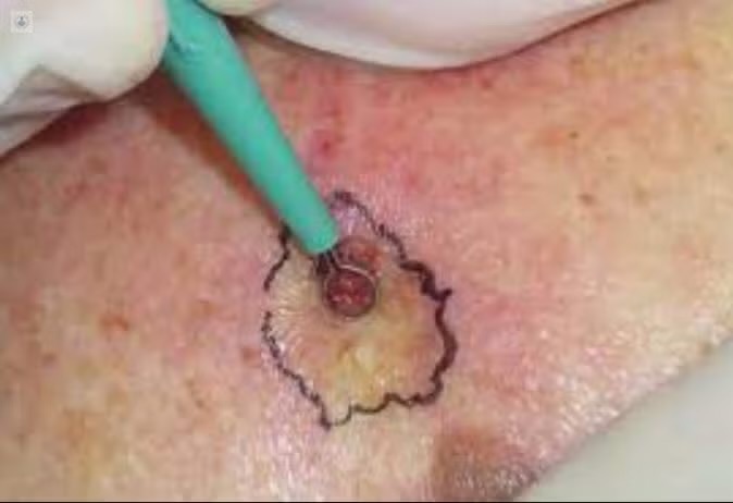 Tratamiento de carcinomas de células basales morfeiformes