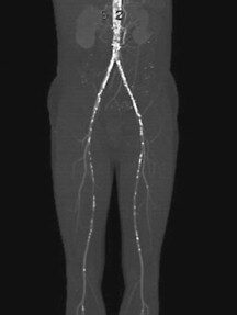 Tratamiento integral de la enfermedad aortoiliaca