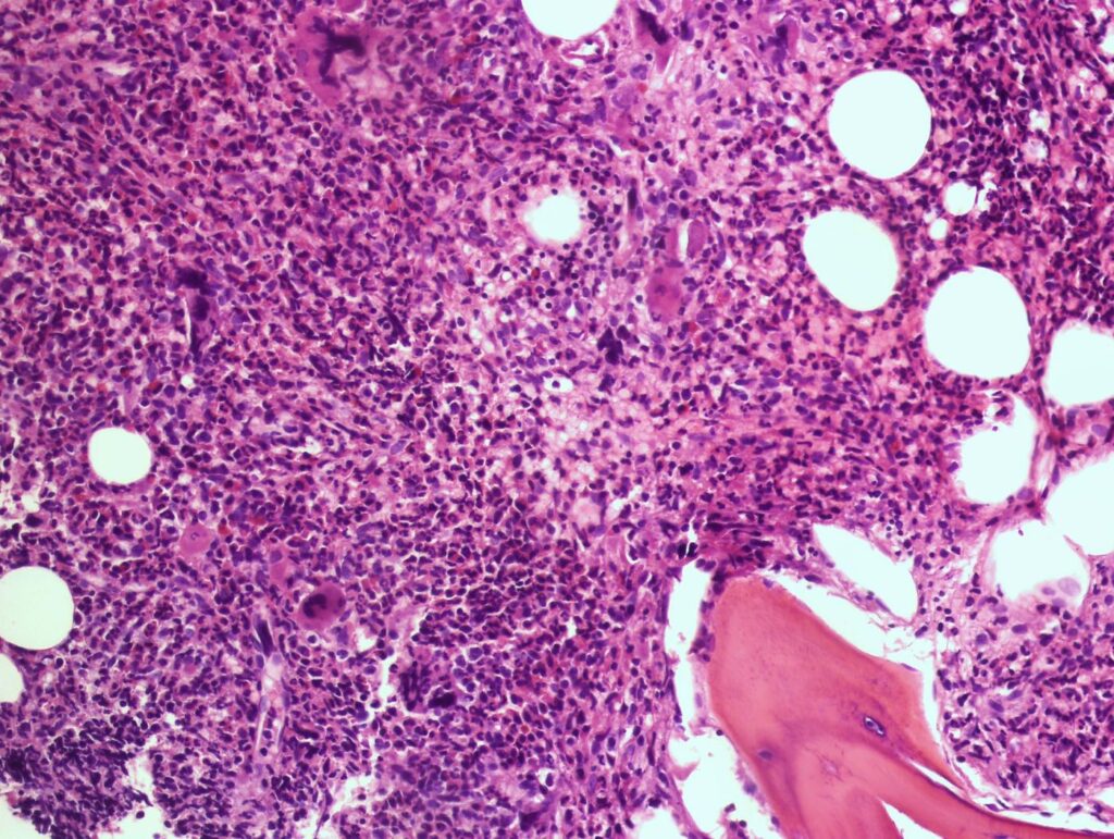 ¿Qué es la mielofibrosis primaria?