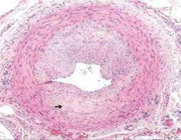arteritis de células gigantes
