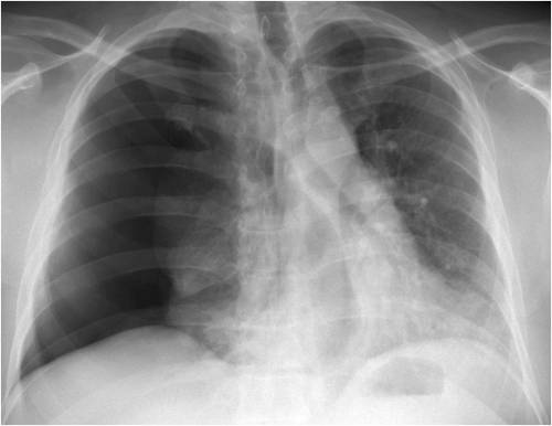 Recurrencia del neumotórax