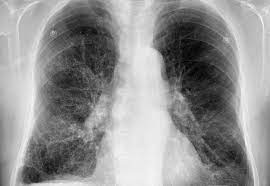 ¿Qué es la enfermedad pulmonar intersticial?