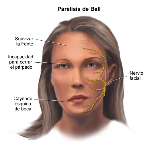 ¿Qué nervio se afecta en la parálisis de Bell?