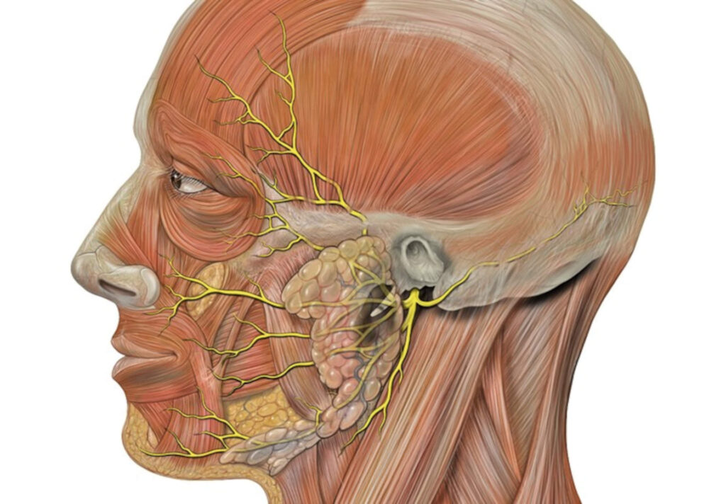 ¿Qué nervio se afecta en la parálisis de Bell?