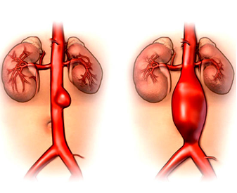 ¿Qué es un aneurisma de la aorta?