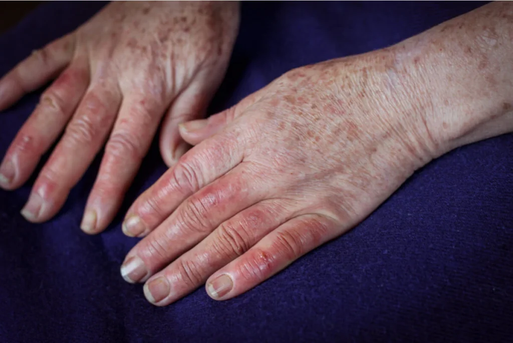 ¿Qué es la tromboangeitis obliterante?