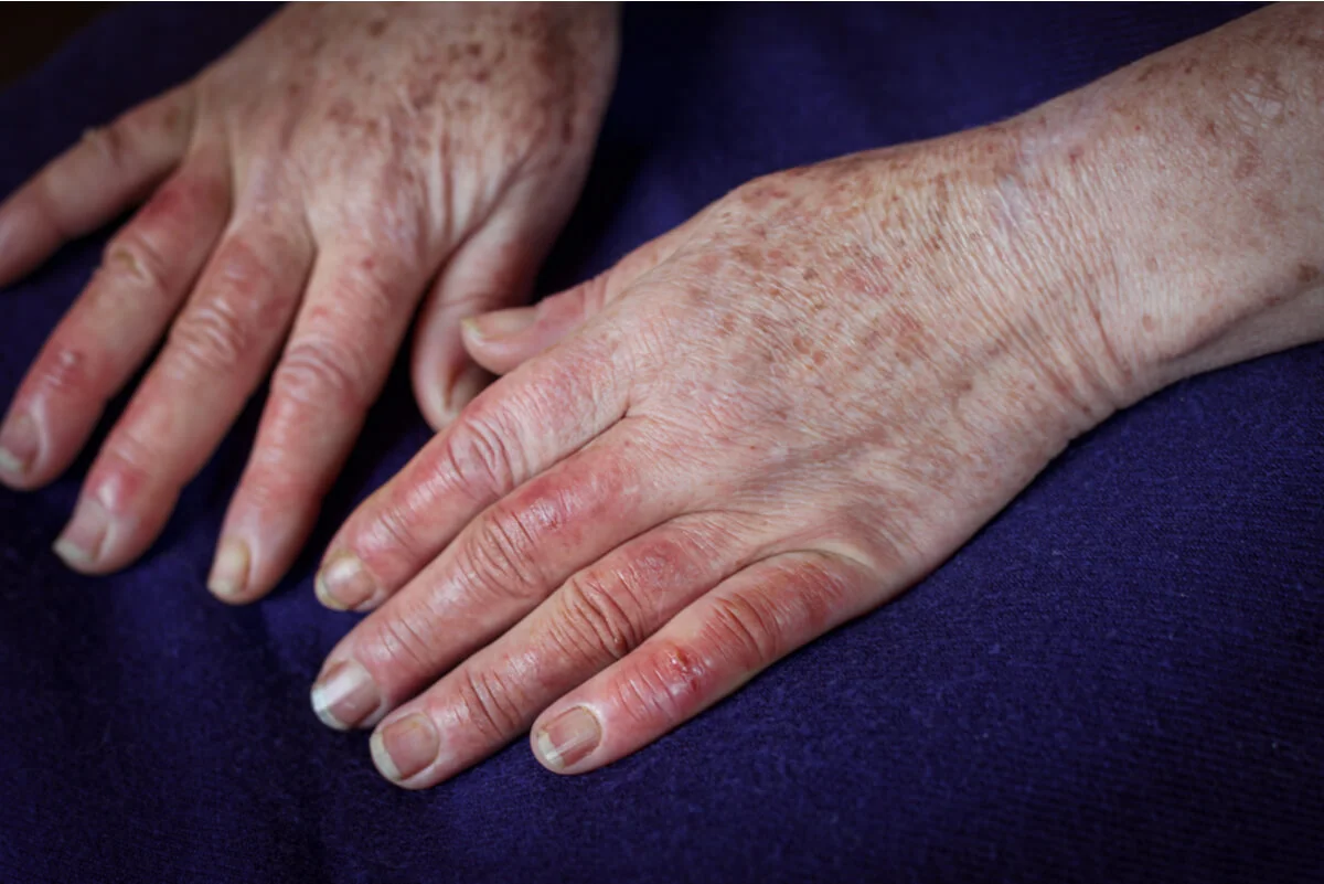 Manifestaciones de la tromboangeítis obliterante