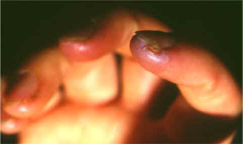 Manifestaciones de la tromboangeítis obliterante