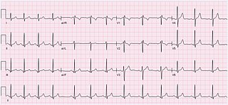 Causa de la arritmia sinusal