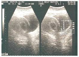 Imagenología para diagnosticar apendicitis en embarazadas