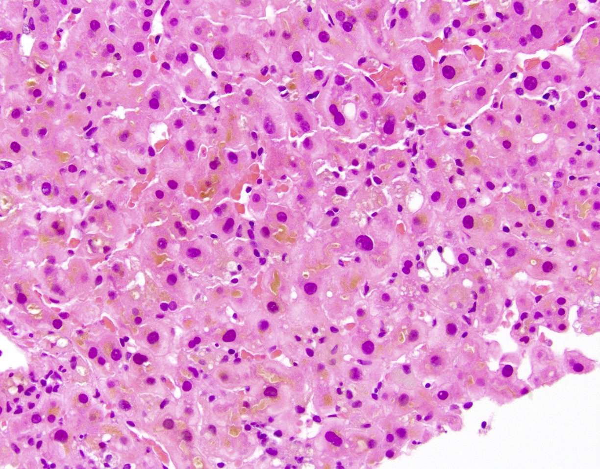 colestasis intrahepática