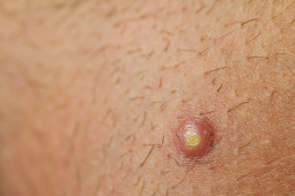 ¿Cuáles son las causas del forúnculo?