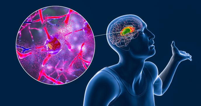 Manifestaciones clínicas de la enfermedad de Huntington