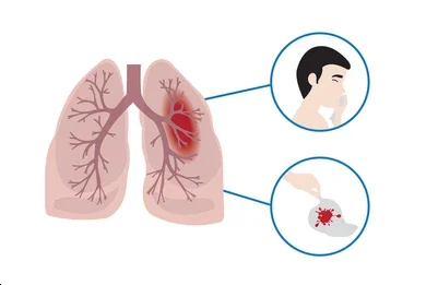 Identificación del origen anatómico de la hemoptisis
