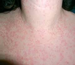 Enfermedad de Still en adultos