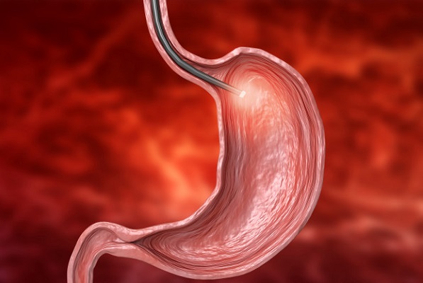 Causas de hemorragia gastrointestinal alta aguda