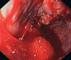 Hemorragia de várices esofágicas