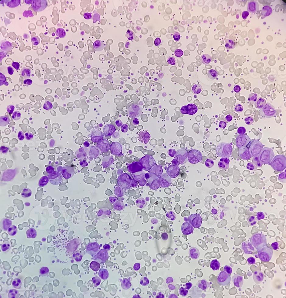 ¿Cuáles son los hallazgos clínicos de la trombocitosis esencial?