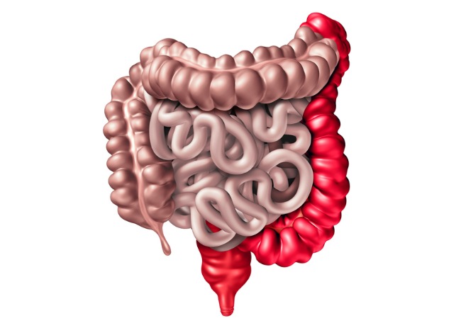 ¿Qué es la colitis ulcerativa?