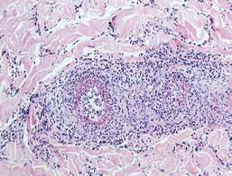 Manifestaciones de la poliangitis microscópica