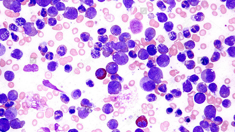 Tratamiento de pacientes con leucemia linfocítica crónica