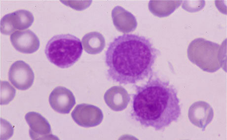 Leucemia de células pilosas
