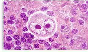 ¿Qué es el linfoma de Hodgkin?