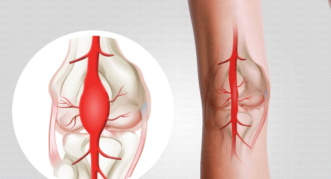 Aneurismas de las arterias periféricas