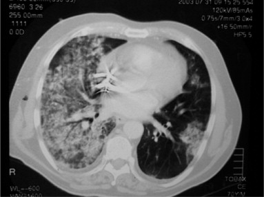 Síndromes de hemorragia alveolar