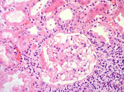 La enfermedad tubulointersticial puede ser aguda o crónica