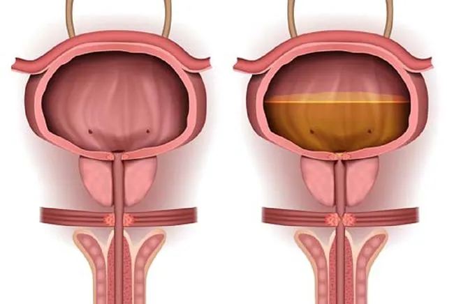 Tratamiento de la hiperactividad del detrusor