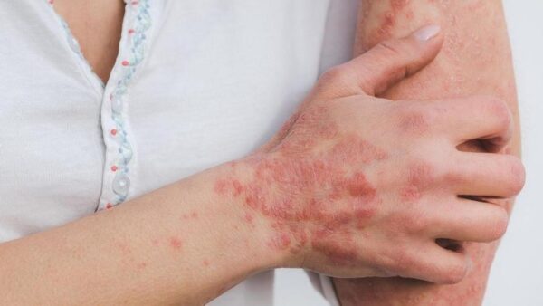 La sarna es una infestación parasitaria