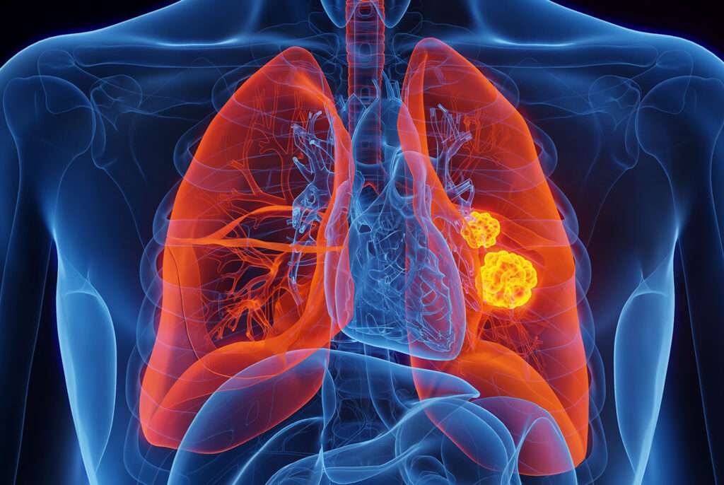 El cáncer de pulmón es la neoplasia que ocasiona más muertes