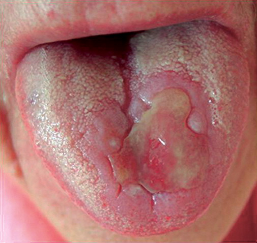 Manifestaciones clínicas de la enfermedad de Behçet