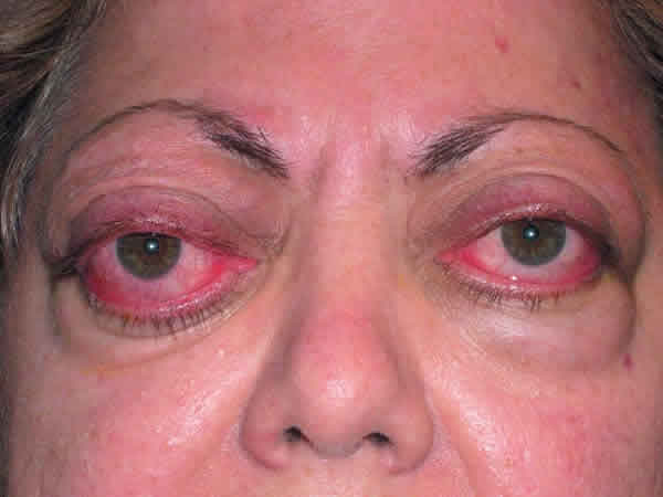 ¿Qué es la orbitopatía de Graves?