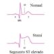 ¿Qué puede causar un infarto agudo de miocardio con elevación del segmento ST?