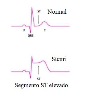 ¿Qué puede causar un infarto agudo de miocardio con elevación del segmento ST?