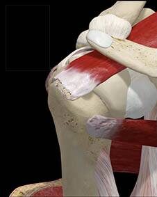 ¿Qué son los desgarros del manguito del rotador del hombro?