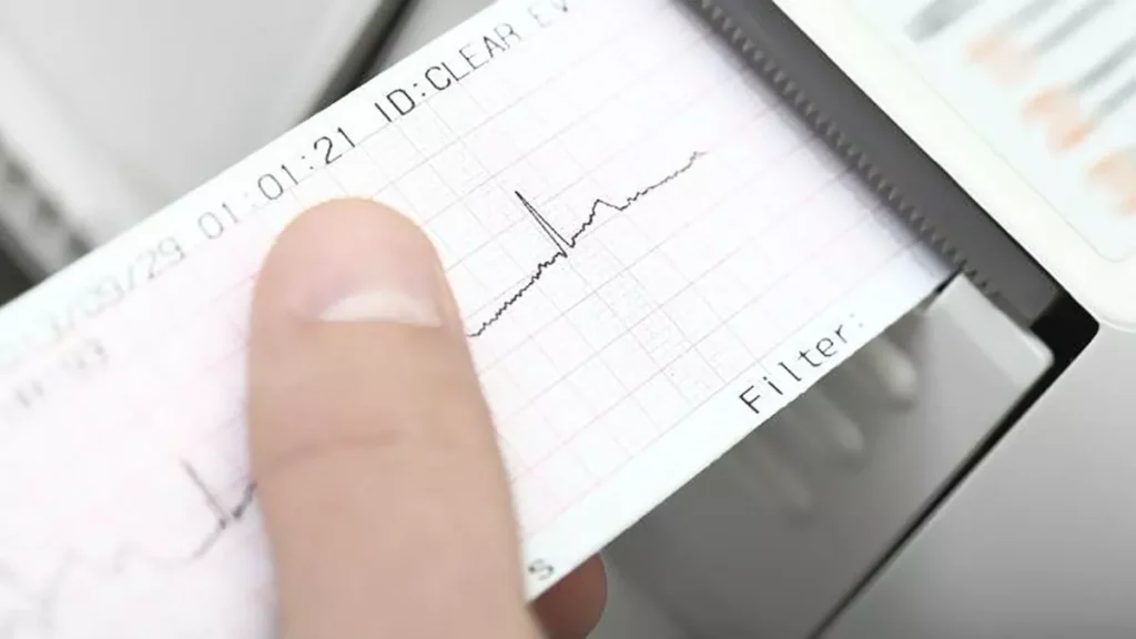 La máquina del electrocardiograma debe estar bien calibrada