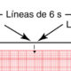 ¿Cuáles son las líneas de tiempo del electrocardiograma?