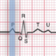 ¿Qué representa la onda P del electrocardiograma?
