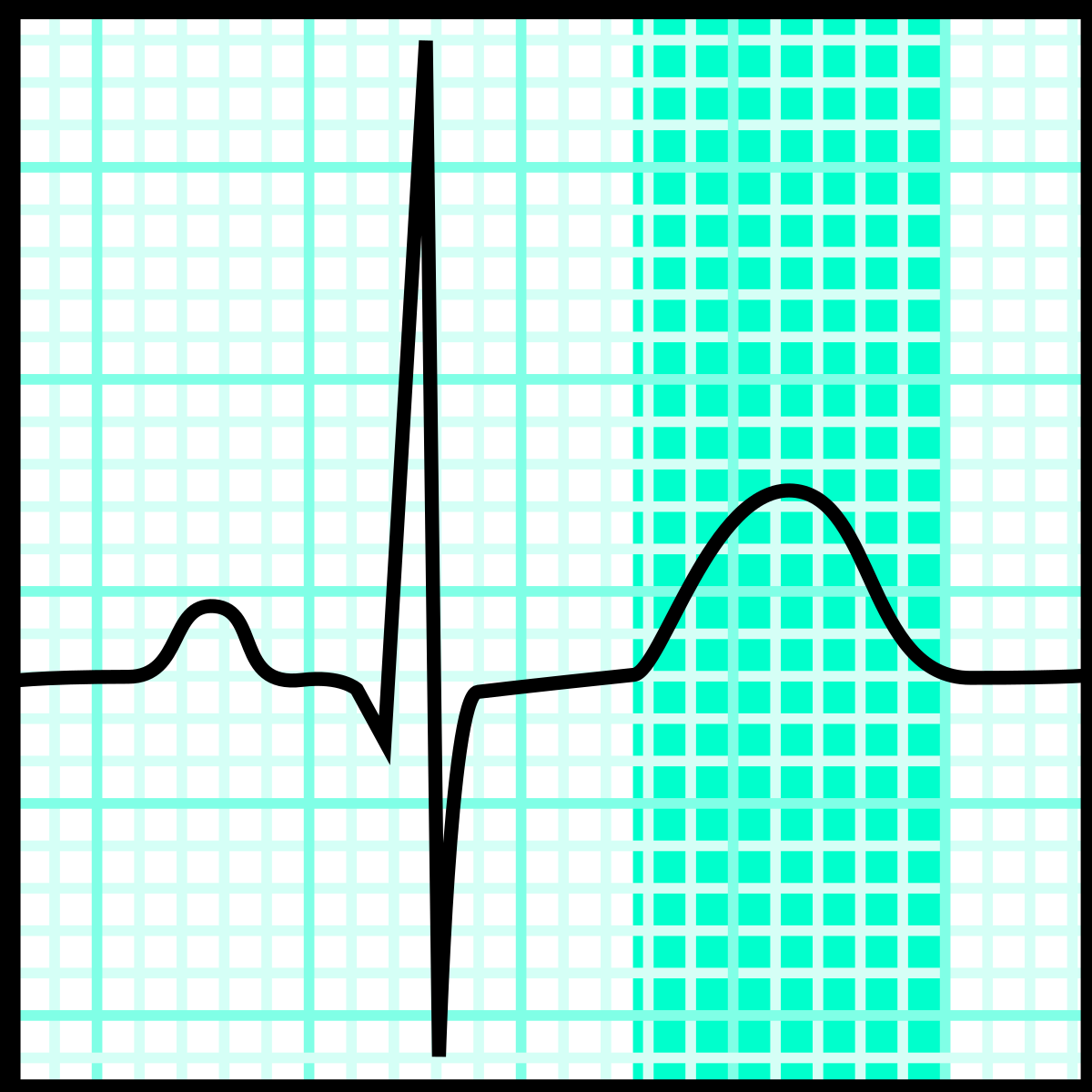 ¿Qué representa la onda T del electrocardiograma? ¿Qué representa la onda T del electrocardiograma?