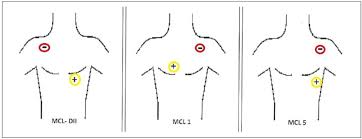 ¿Qué es la derivación torácica modificada?