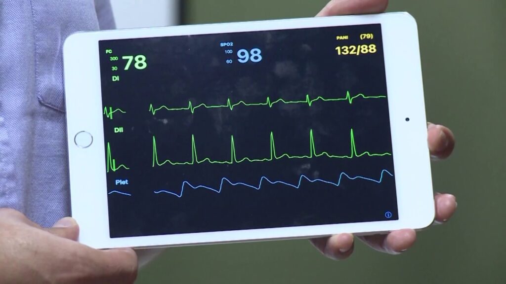 Monitoreo cardiaco con la derivación DII