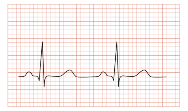 Registros positivos y negativos en las derivaciones.