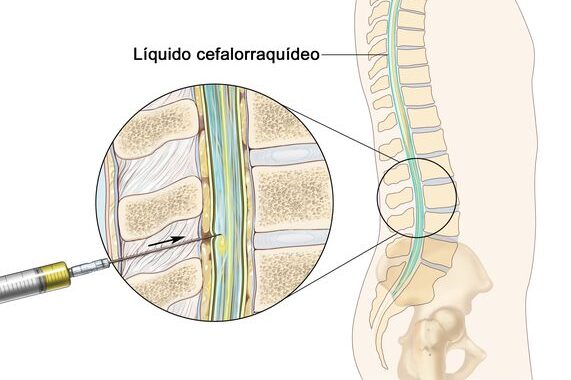 Administración intratecal de medicamentos