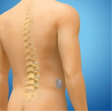 Estimulación de la médula espinal para manejo del dolor