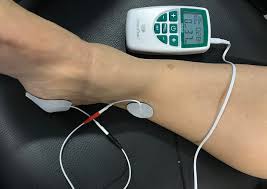 ¿Para que sirve la estimulación de nervio pariférico?