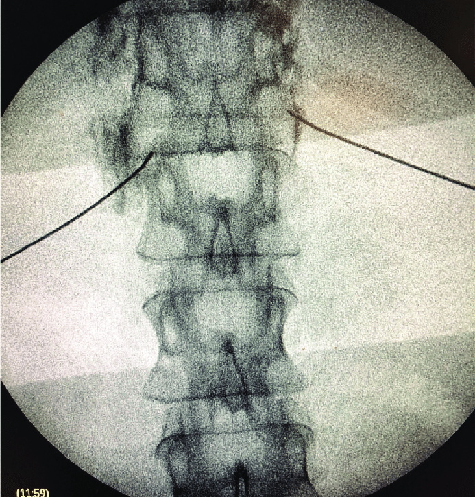 Bloqueo y neurolisis del plexo celíaco