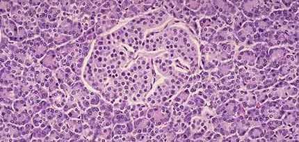 Patogenia de la diabetes mellitus tipo 1